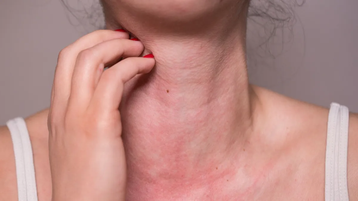 Dị ứng thức ăn bao lâu thì hết? Cách xử lý khi bị dị ứng thức ăn