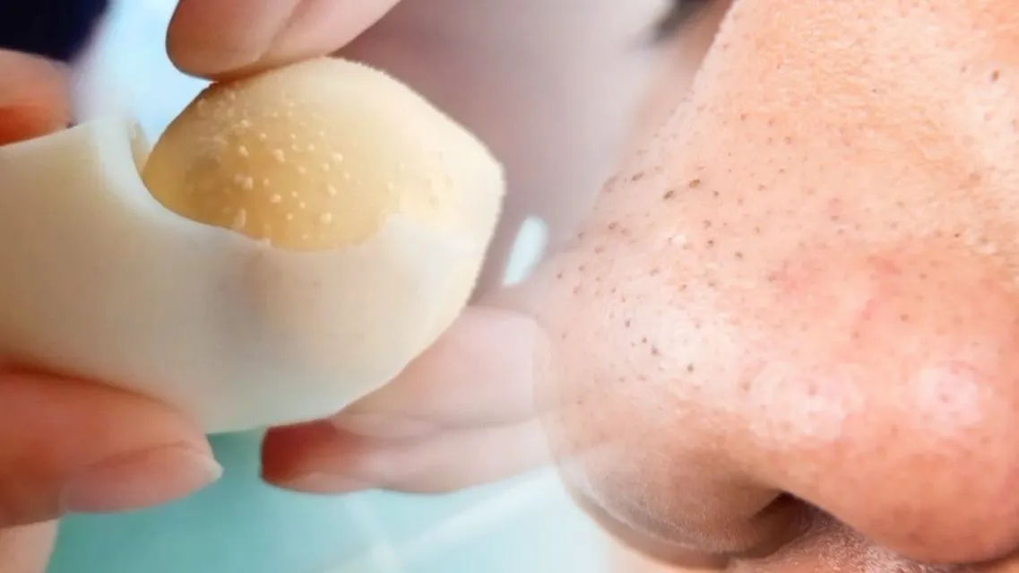 Lăn trứng gà trị mụn: Hiệu quả thật hay chỉ là mẹo dân gian?