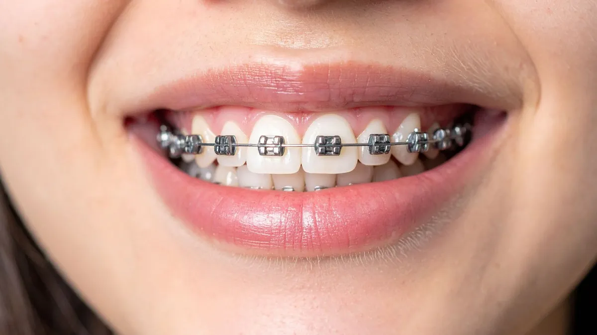Đi du học có niềng răng được không? Lưu ý cần biết khi niềng răng