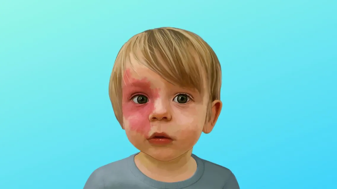Những điều cần biết về ảnh hưởng của bớt rượu vang và cách điều trị