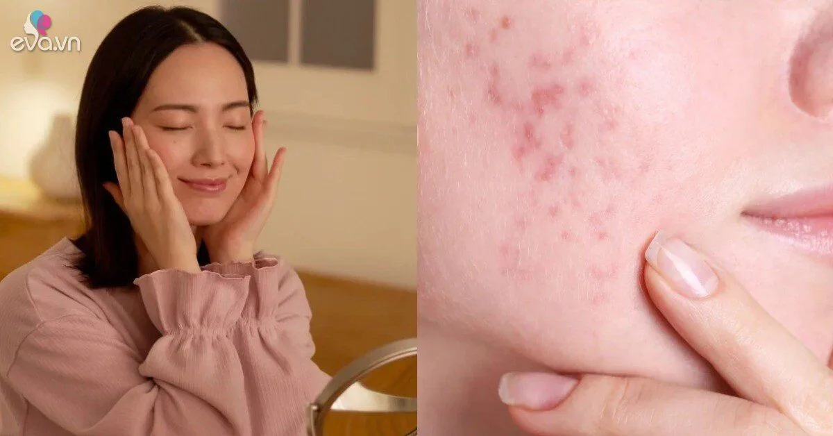 Tưởng chăm da kỹ, ai ngờ 5 thói quen này lại khiến lỗ chân lông nở to, da xuống cấp nhanh chóng