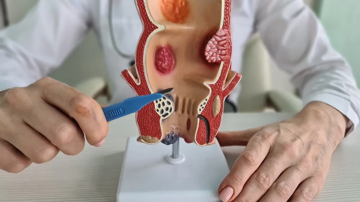 Nổi hạch gần hậu môn là bệnh gì? Khi nào cần đi khám bác sĩ?