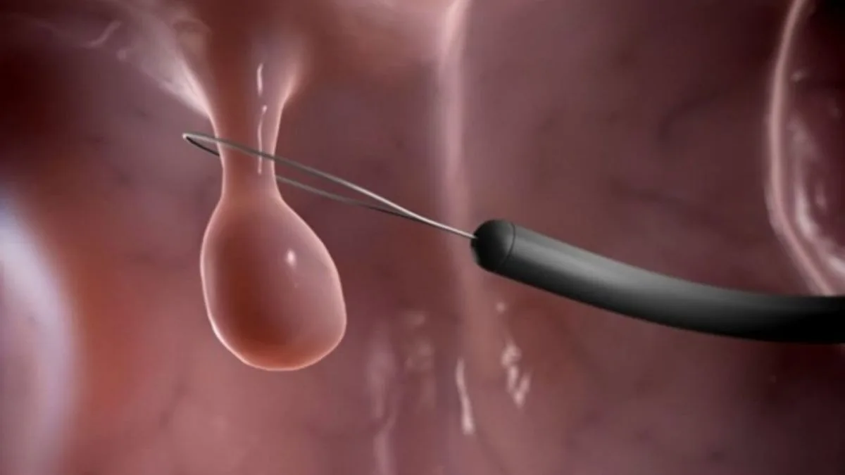 Polyp cổ tử cung và những điều cần biết