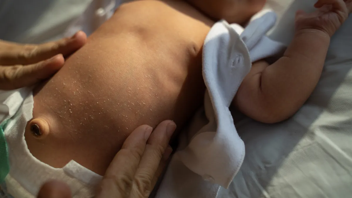 Hình ảnh rốn lồi ở trẻ sơ sinh và khi nào cần đưa bé đi khám?