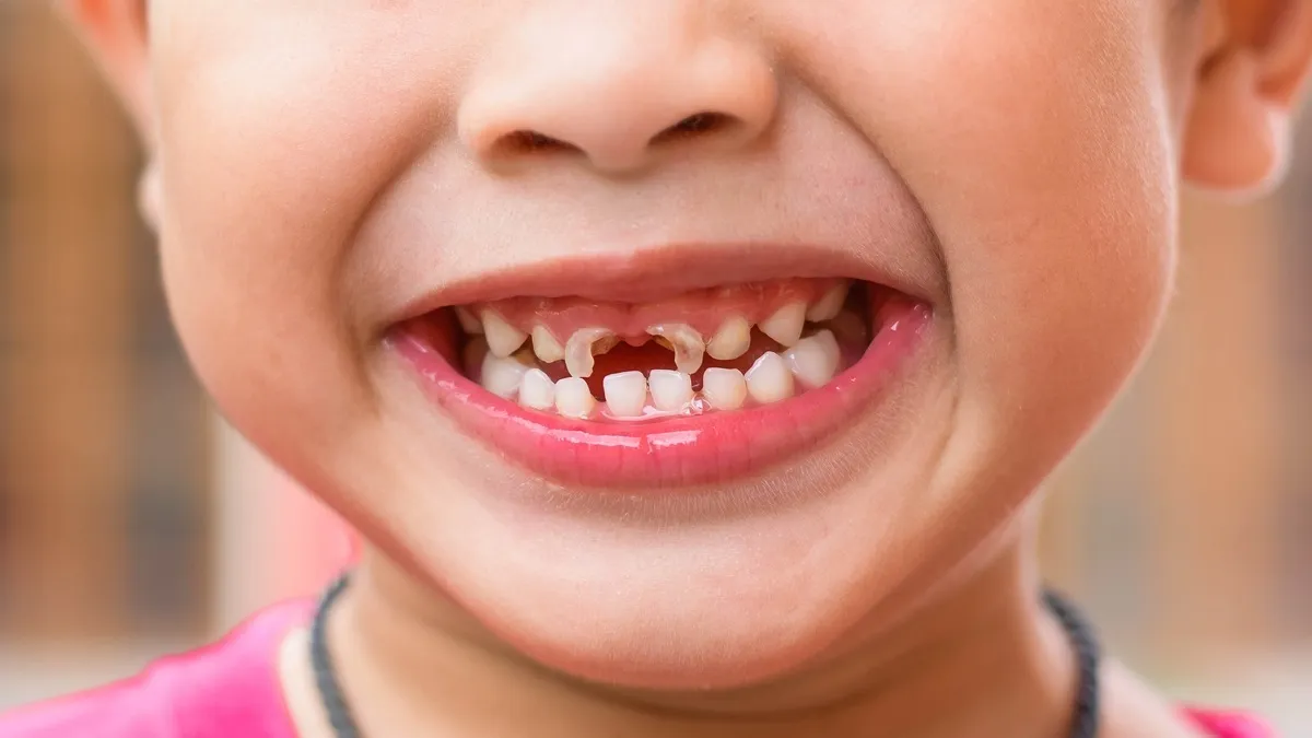 Răng sữa là gì? Thông tin quan trọng cần biết về răng sữa