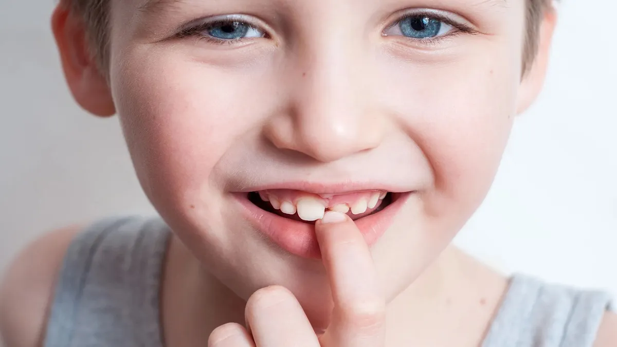 Trẻ 7 tuổi chưa thay răng sữa có sao không?