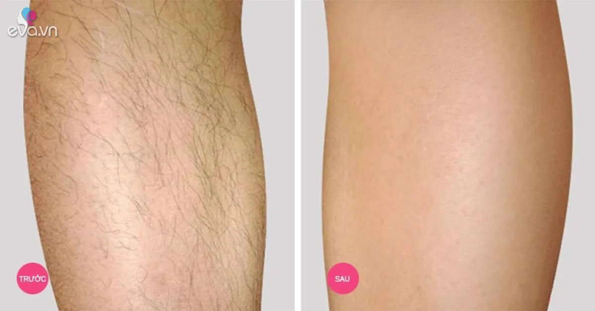 Hè rồi, đi biển chẳng dám mặc bikini vì chân nhiều lông, hãy áp dụng ngay 2 công thức này