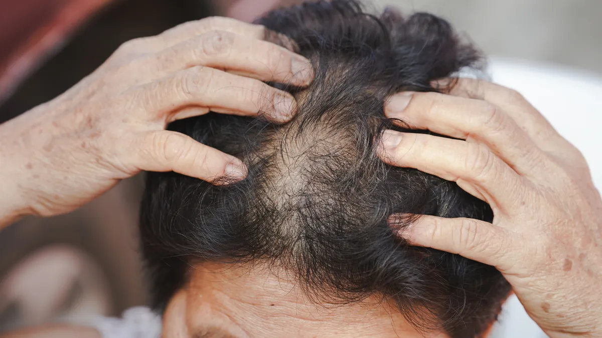 Rụng tóc ở phụ nữ trung niên có khắc phục được không?