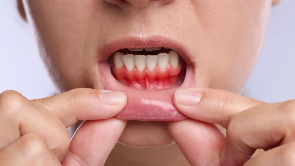 Gôm mềm là dấu hiệu của bệnh gì? Khi nào cần khám tại cơ sở y tế?