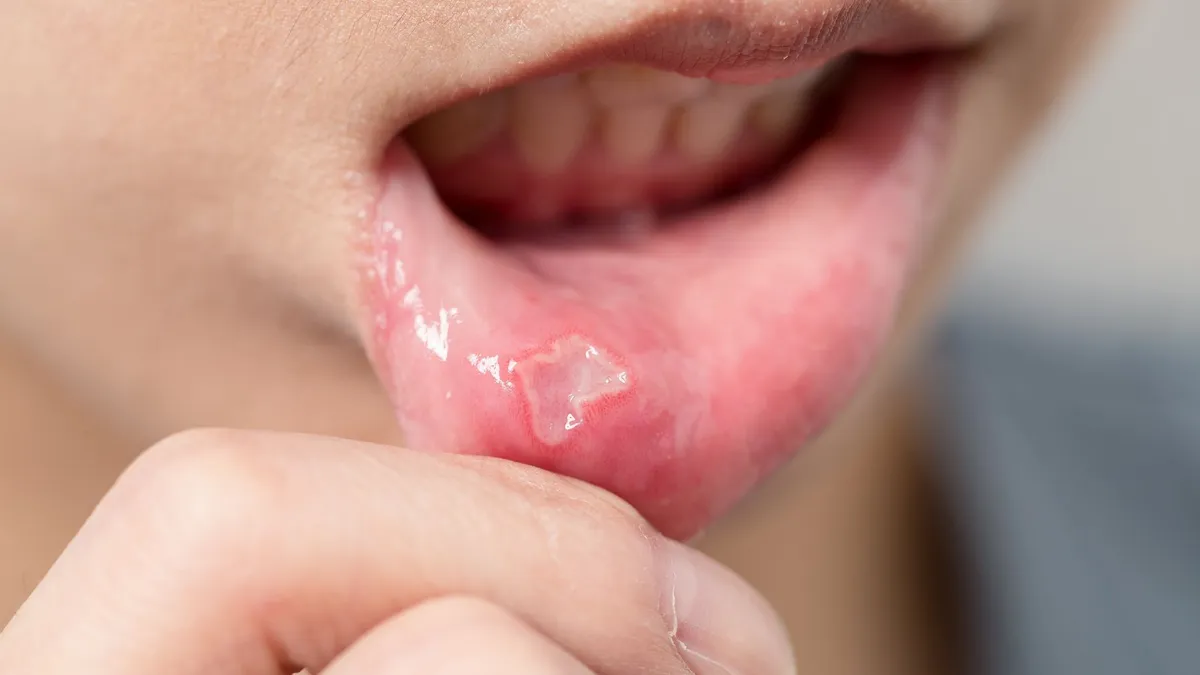 Có nên bôi thuốc vào vết loét tay chân miệng ở trẻ không?