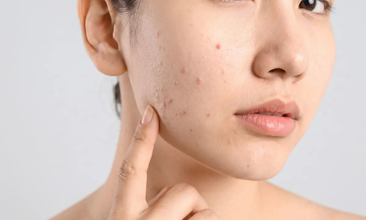 Có nên nặn mụn sau khi peel da không? Những điều cần lưu ý