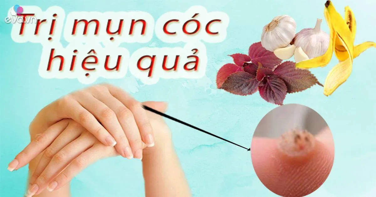 Tổng hợp cách trị mụn cóc an toàn - hiệu quả ngay từ lần đầu tiên!