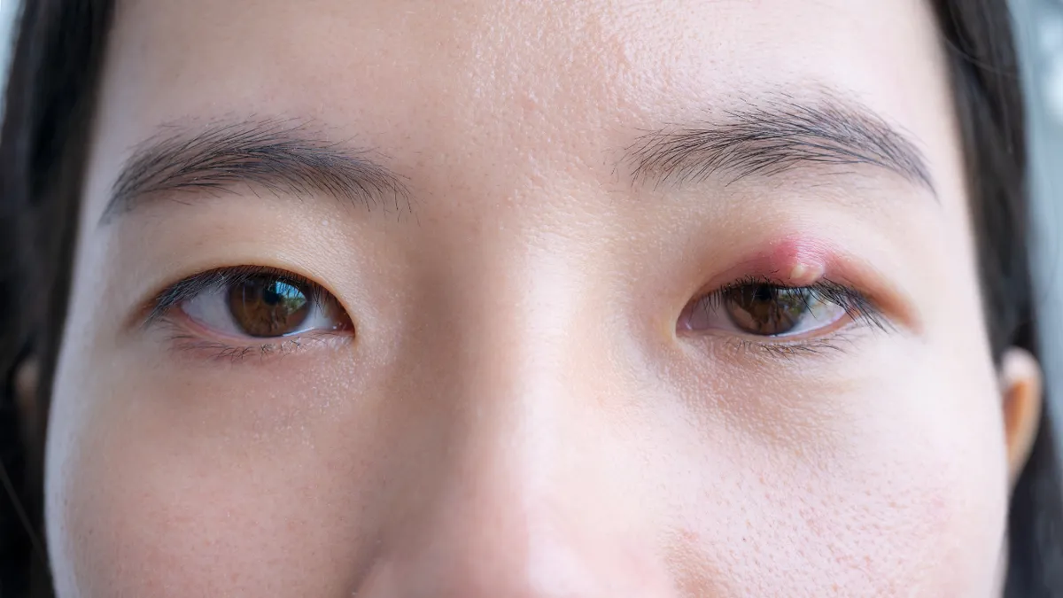 Áp xe mắt là gì? Nguyên nhân gây bệnh và cách điều trị hiệu quả