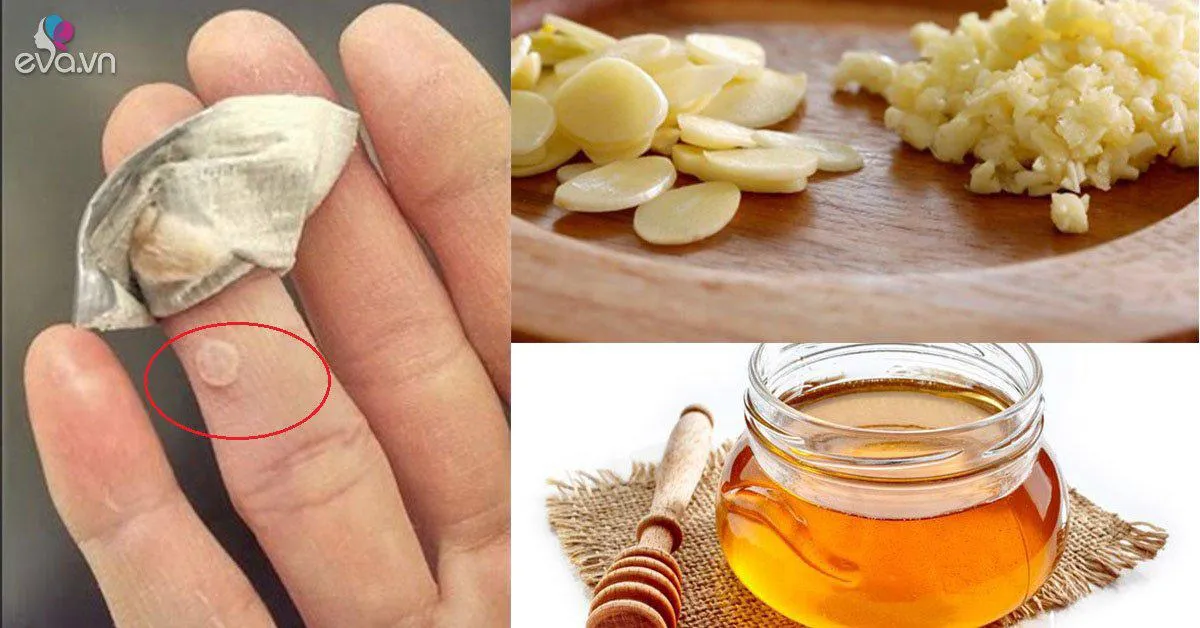 Bất ngờ với các cách trị mụn cóc ở chân tại nhà, khiến mụn "một đi không trở lại"!