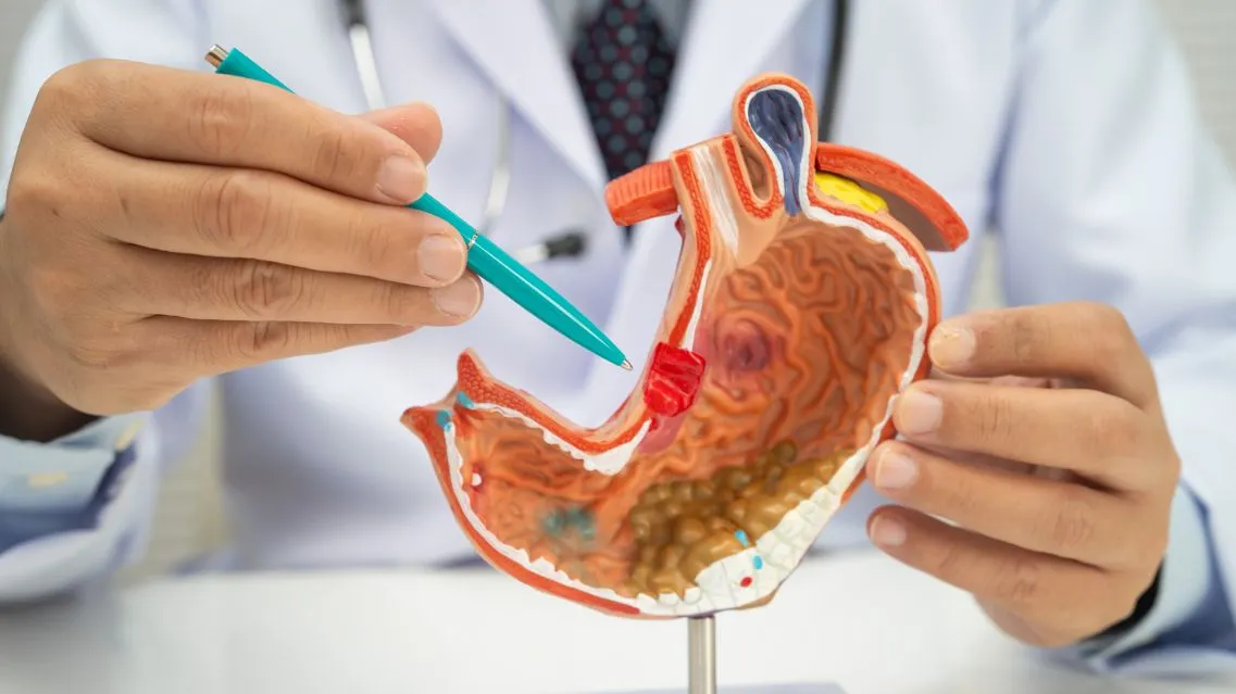 Các triệu chứng ung thư dạ dày giai đoạn đầu thường gặp