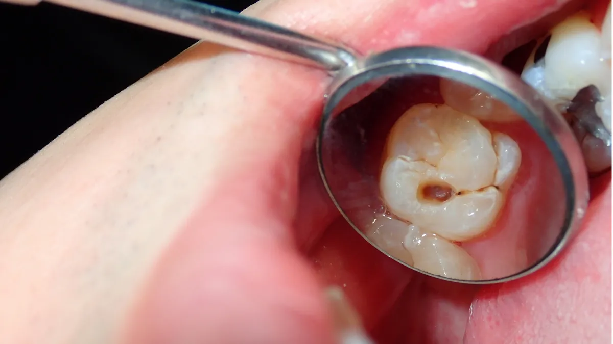 Em bé ăn kẹo bị sâu răng do đâu? Cách bảo vệ răng miệng