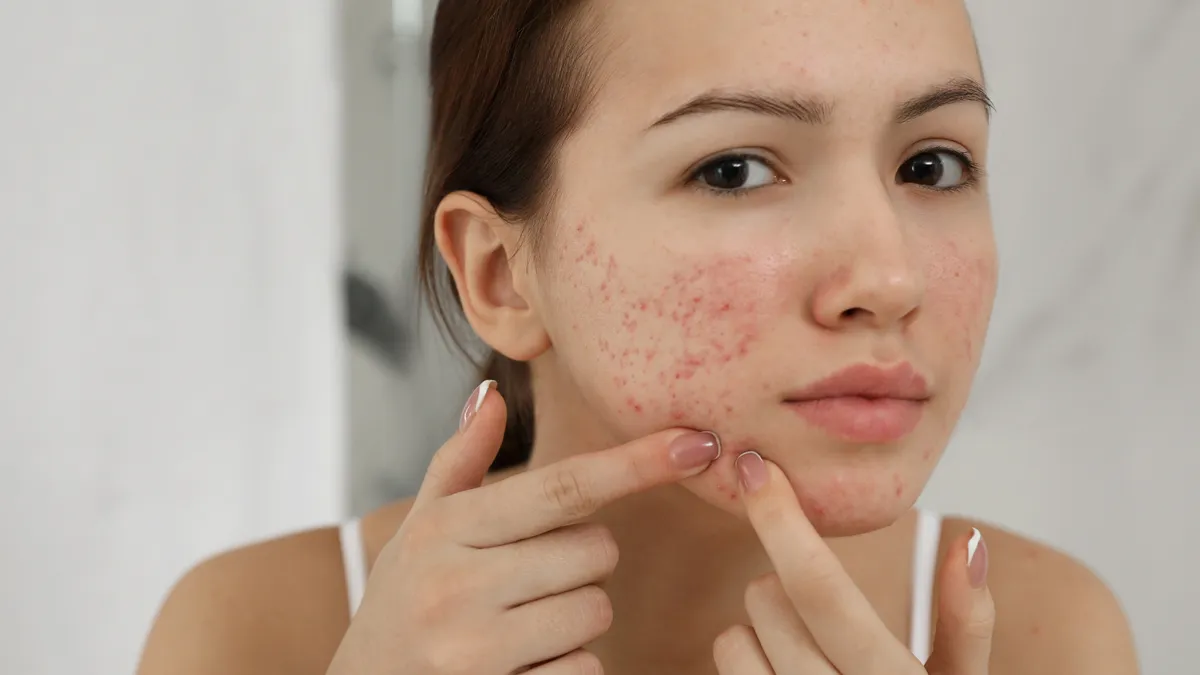 Uống viên cấp nước bị nổi mụn là do đâu? Cách xử trí hiệu quả