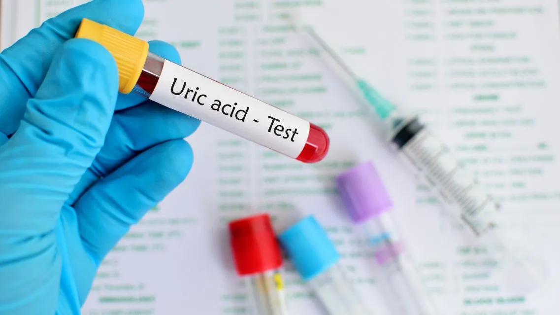 Xét nghiệm acid uric máu là gì? Ý nghĩa, quy trình và giá