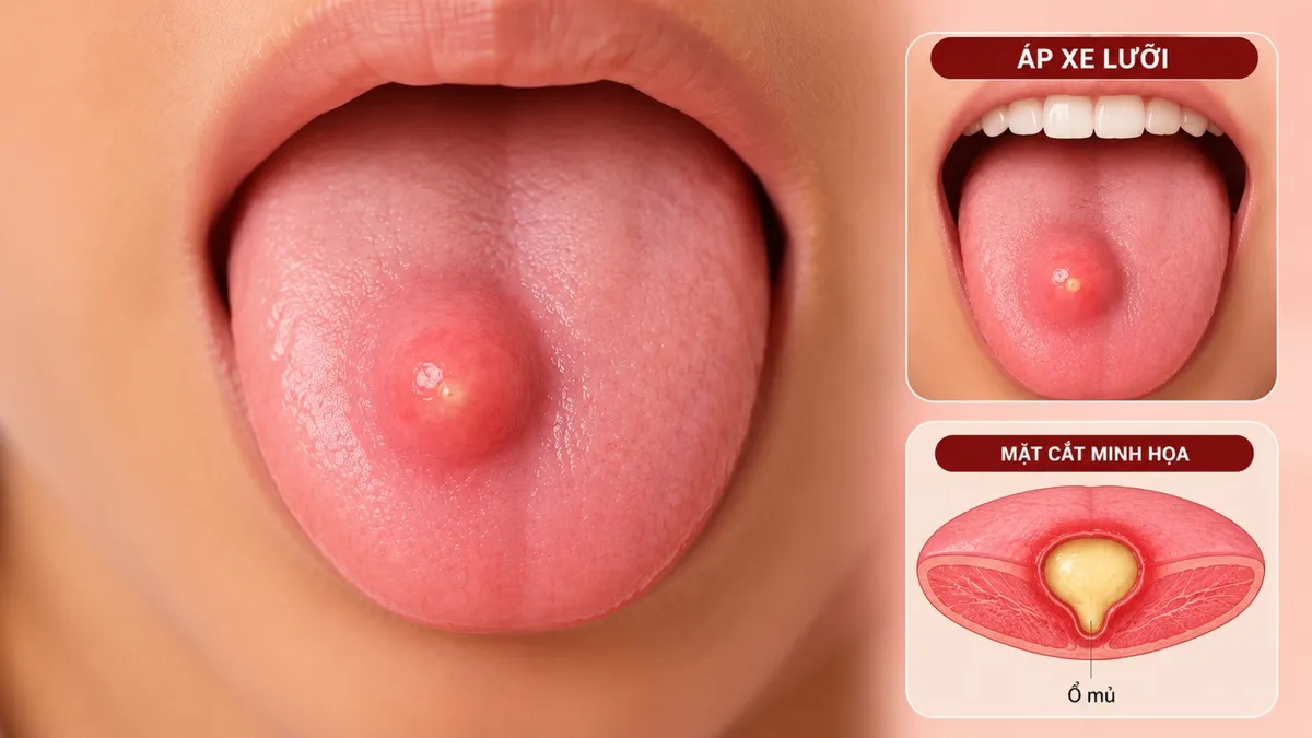 Áp xe lưỡi: Nguyên nhân, triệu chứng và cách điều trị