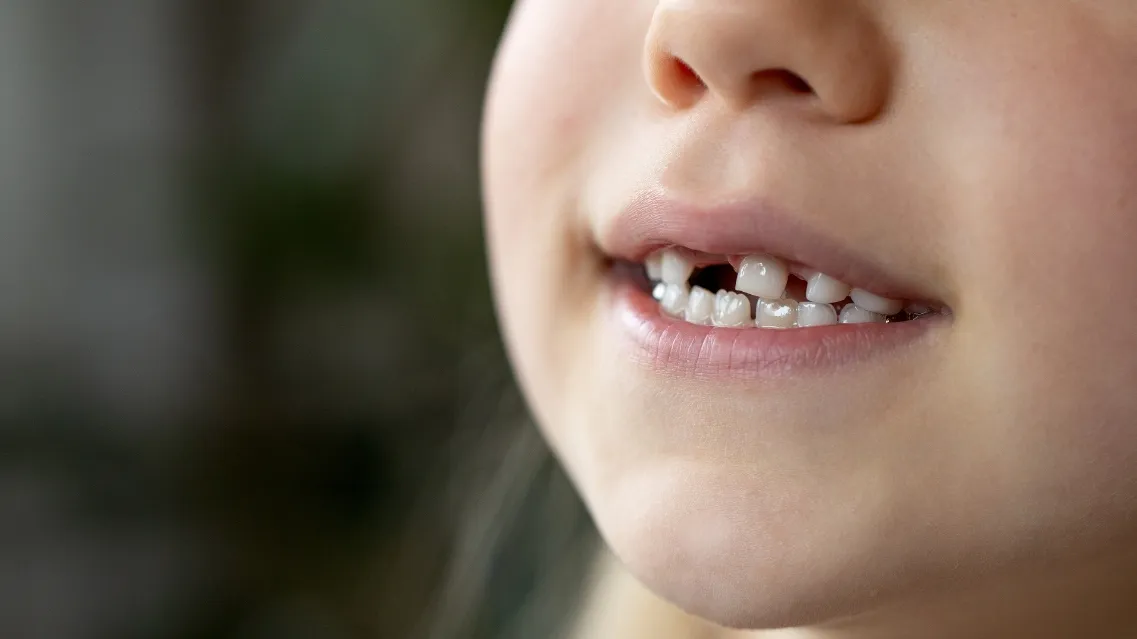 Thay răng sớm có dậy thì sớm không? Những điều cha mẹ cần biết