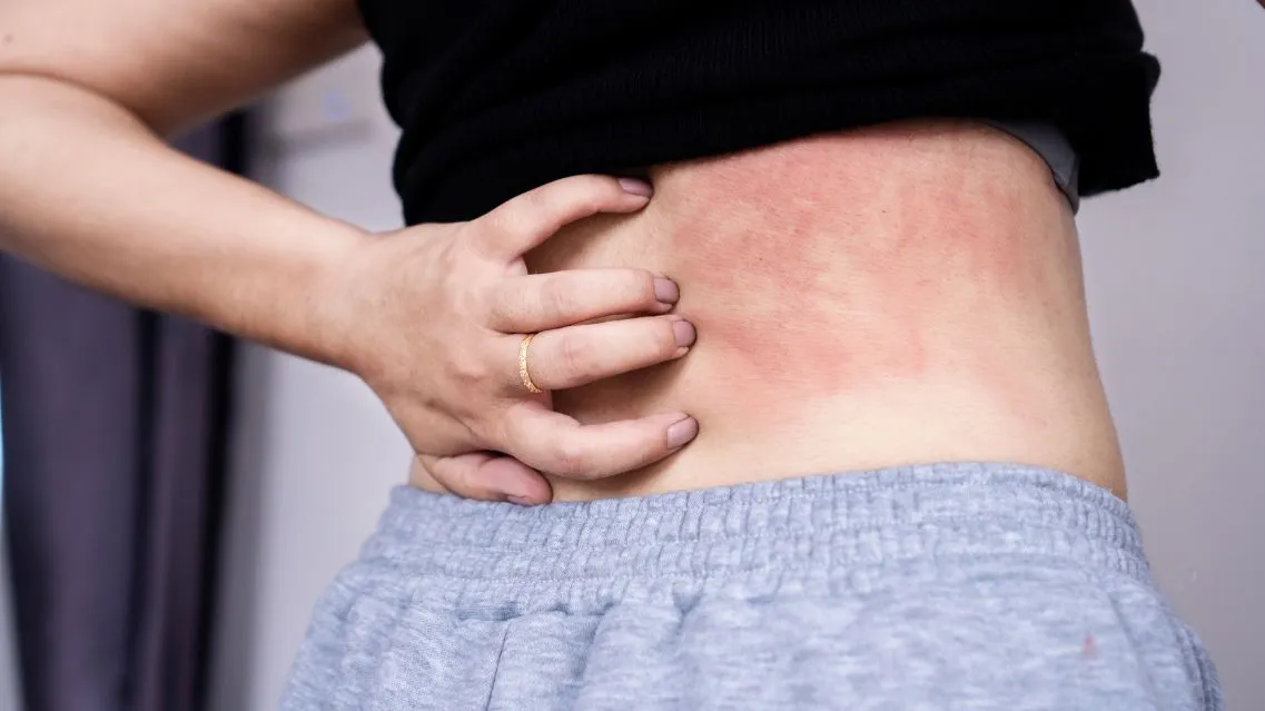 Mẩn ngứa khắp người là dấu hiệu bệnh gì? Nguyên nhân và cách xử lý