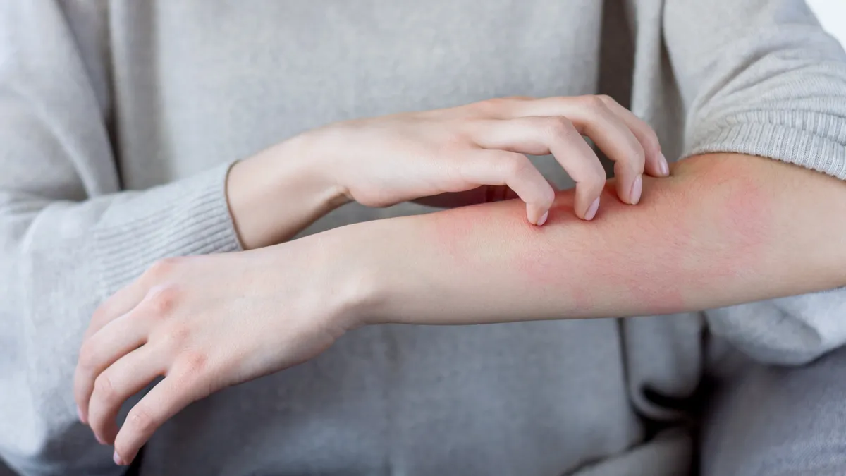 Dị ứng chéo là gì? Dấu hiệu, phân loại và cách phòng ngừa