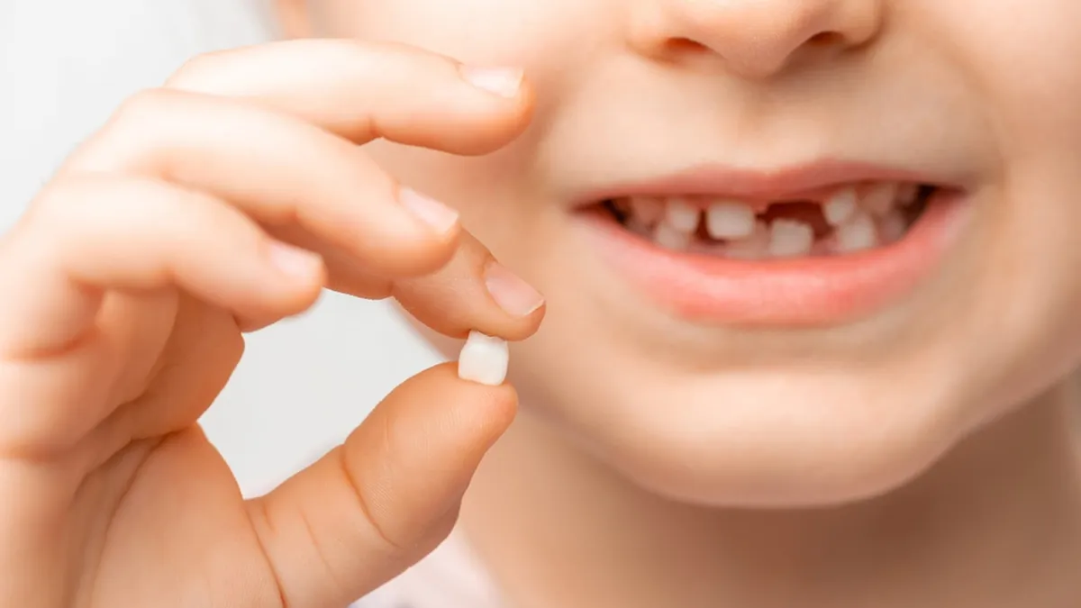 Răng sữa bị sâu: Nguyên nhân và phương pháp điều trị tại nhà