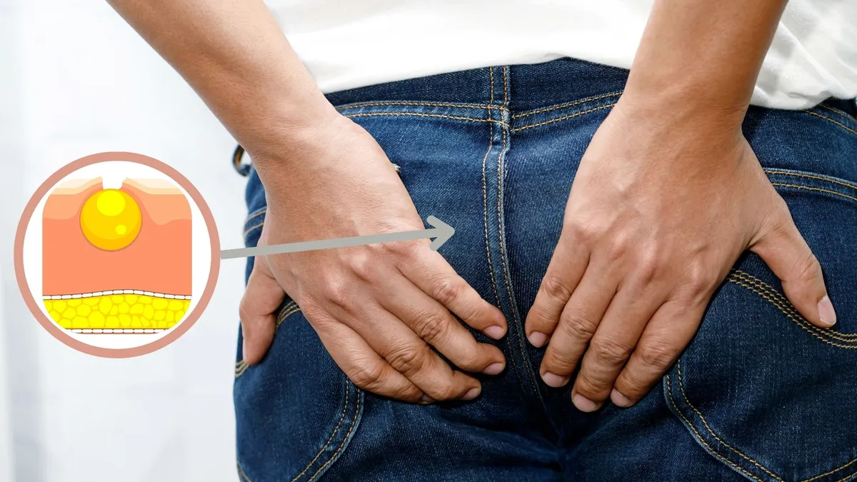 U bã đậu ở mông: Nguyên nhân, dấu hiệu và cách điều trị hiệu quả