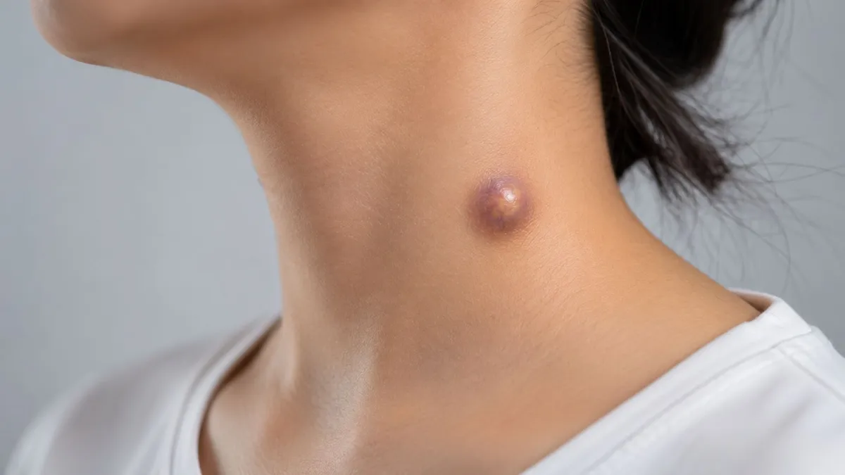 U bã đậu ở cổ: Nguyên nhân, dấu hiệu và cách điều trị hiệu quả
