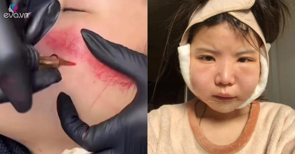 Những trào lưu thẩm mỹ kỳ lạ của giới trẻ, ngay cả bác sĩ "dao kéo" cũng phải hốt hoảng