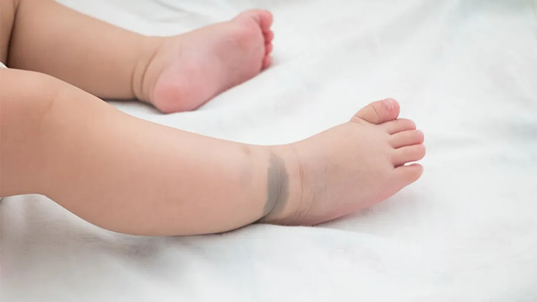 Bớt xanh trên cơ thể trẻ sơ sinh là gì?
