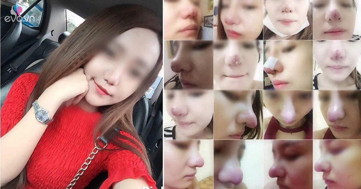 Bỏ 25 triệu làm mũi và bị hỏng, cô gái phải chịu 9 lần khâu lại không thuốc tê!