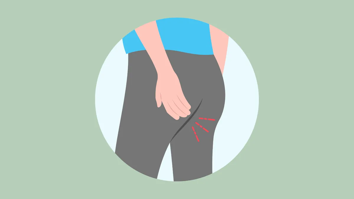 Rò hậu môn xuyên cơ thắt: Thông tin quan trọng cần biết