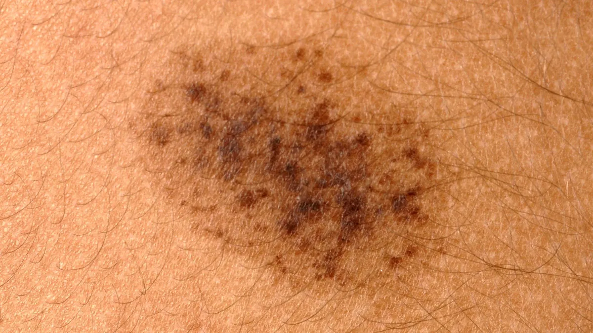 Bớt spilus: Nguyên nhân, mức độ nguy hiểm và phương pháp điều trị