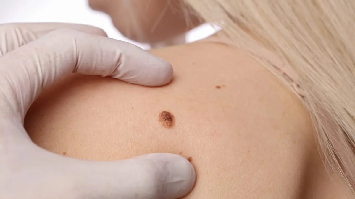 Bớt sắc tố bẩm sinh: Nguyên nhân, nhận biết và cách xử lý an toàn