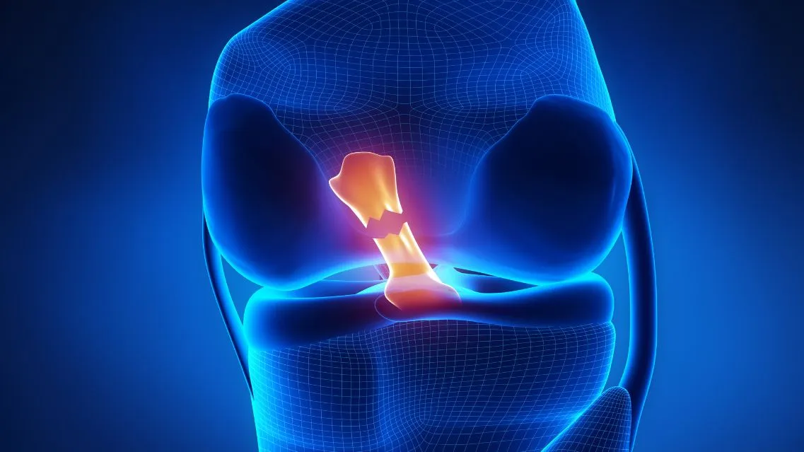 Đứt dây chằng chéo trước có đá bóng được không? Giải đáp từ chuyên gia