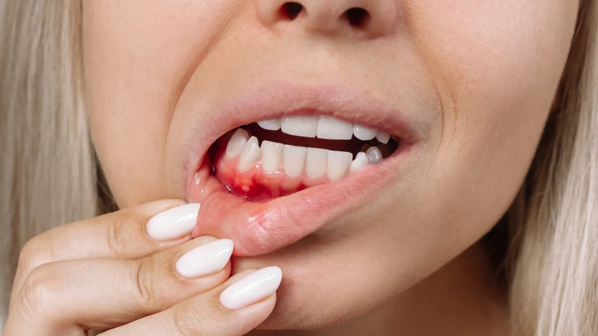 Bà bầu bị chảy máu chân răng là thiếu chất gì?