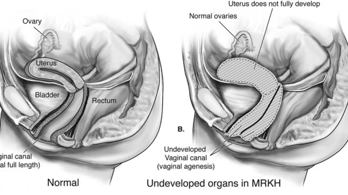 Hội chứng Mayer Rokitansky Kuster Hauser: Nguyên nhân và điều trị