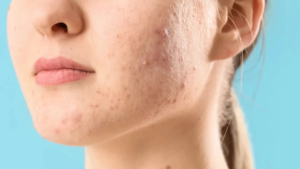 Người bị mụn mủ kiêng ăn gì nhanh khỏi?