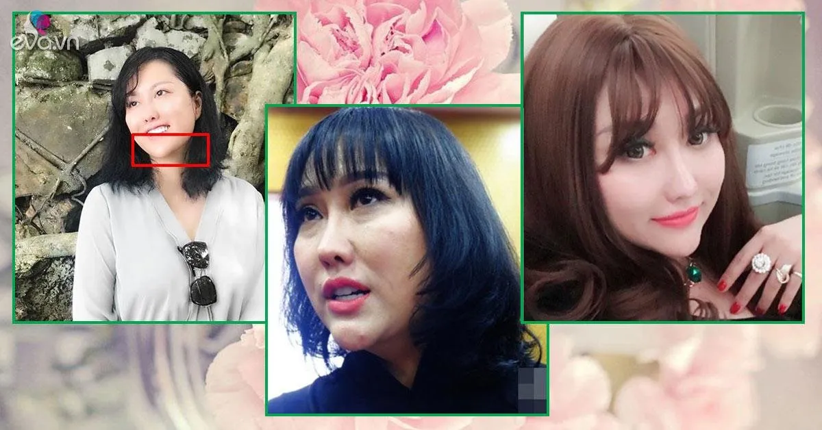 Mũi biến dạng, cằm lệch một bên, Phi Thanh Vân đối diện với biến chứng sau nhiều lần dao kéo?
