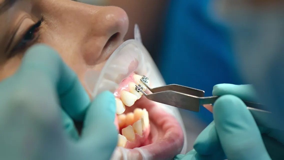 Mất răng số 5 có niềng được không? Giải pháp là gì?