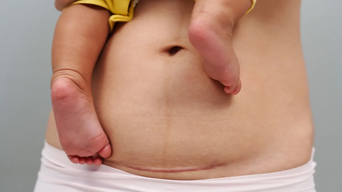 Vết mổ sau sinh bao lâu thì hết đau? Lưu ý khi chăm sóc