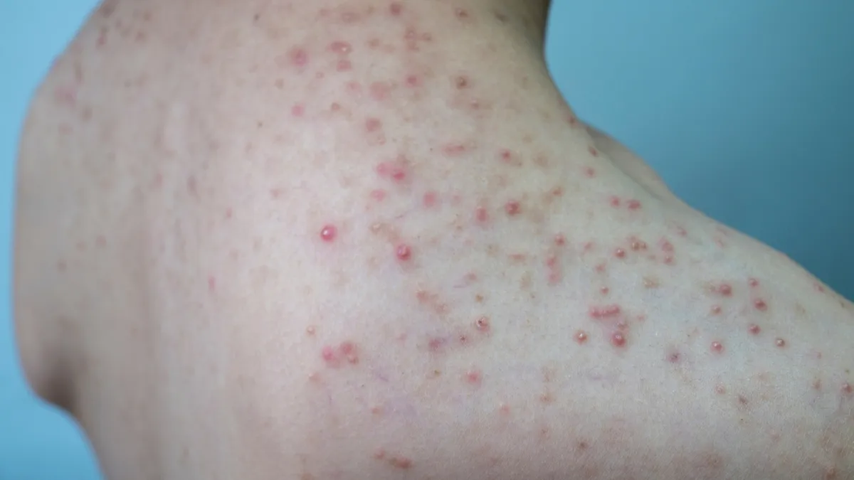 Người hay nổi mụn nhọt là bị bệnh gì? Nguyên nhân và cách khắc phục hiệu quả