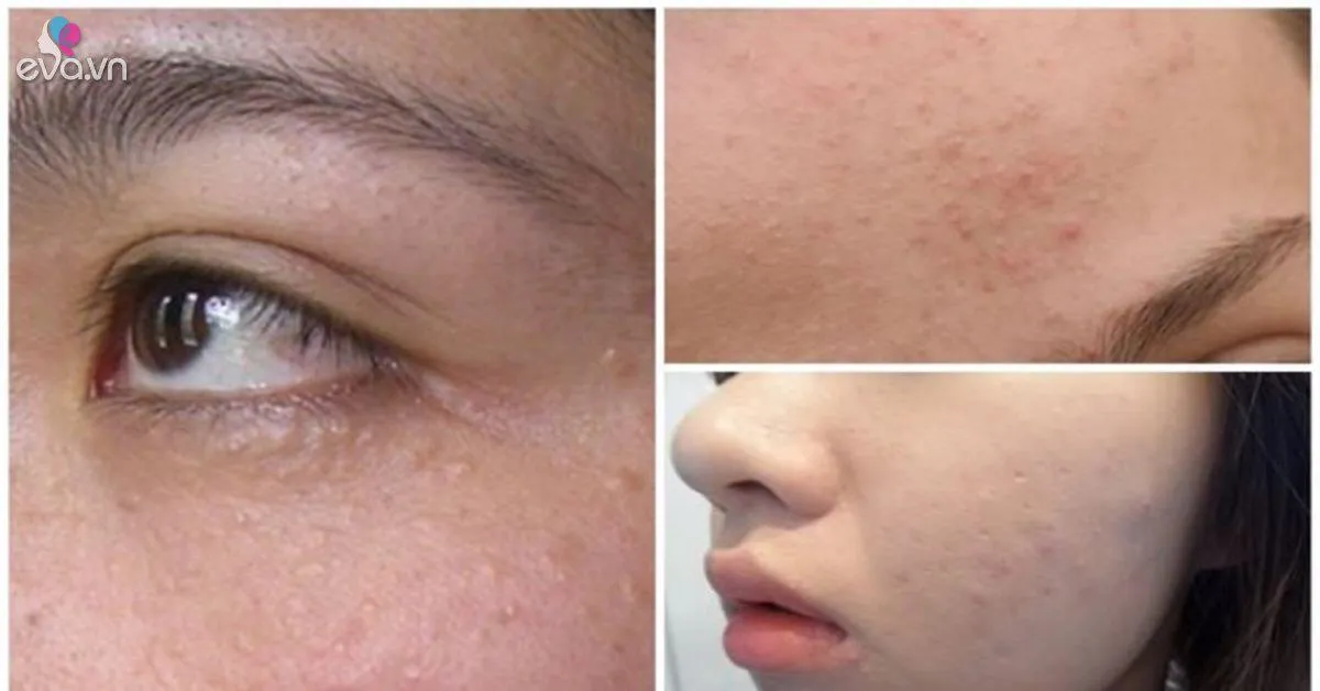 Trị mụn ẩn dưới da siêu hiệu quả từ những bí quyết thần thánh sau