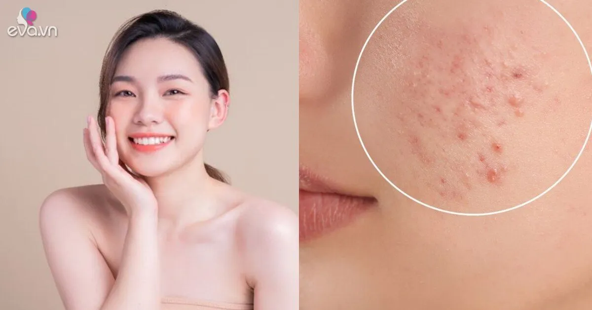 Da dễ sạm, đổ dầu và nổi mụn mùa Hè? Đây là những cách giúp làn da sáng khỏe hơn mỗi ngày