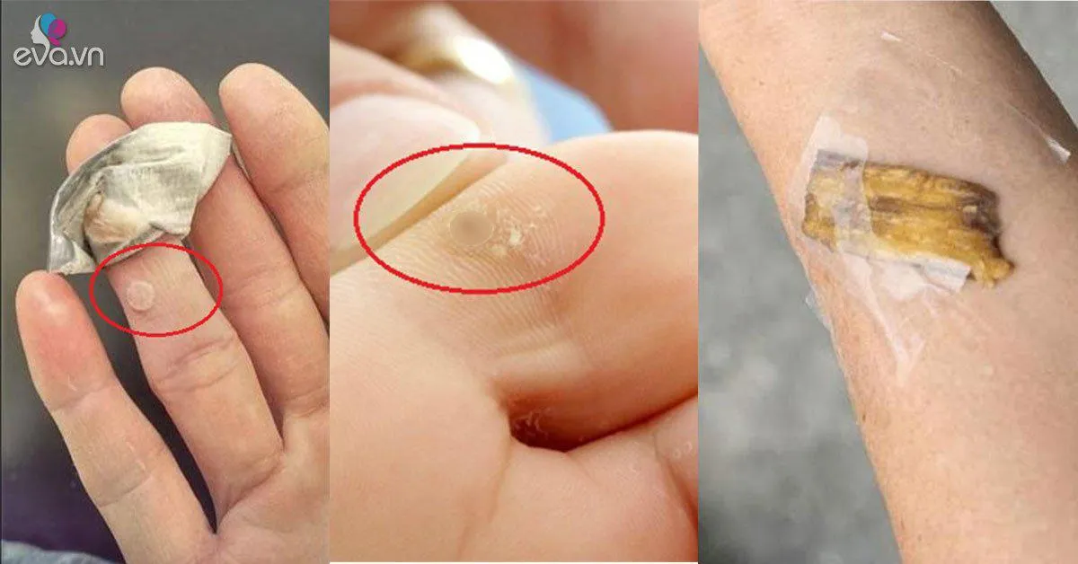 Truyền tay nhau cách trị mụn cóc này, hàng nghìn chị em đã chữa khỏi tận gốc!