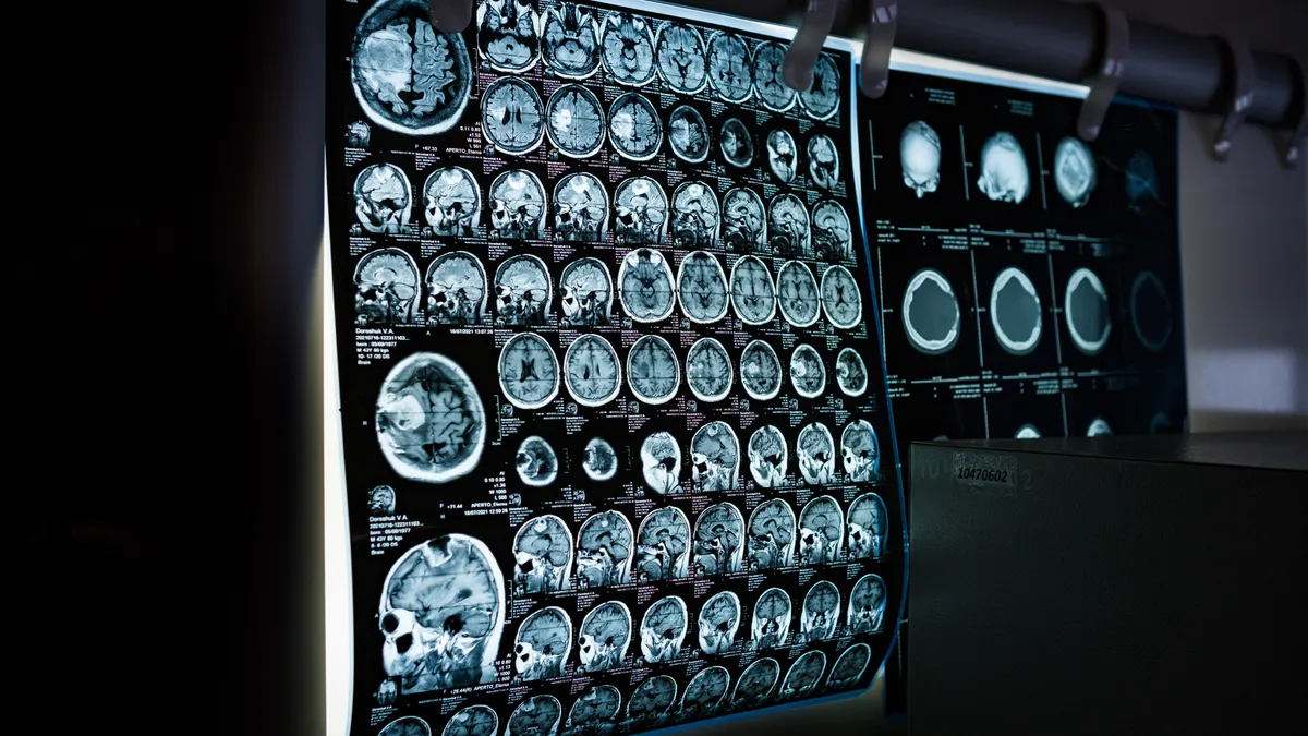 Phương pháp MRI mới có thể dự đoán nguy cơ mắc bệnh tim bằng cách phân tích mỡ tim