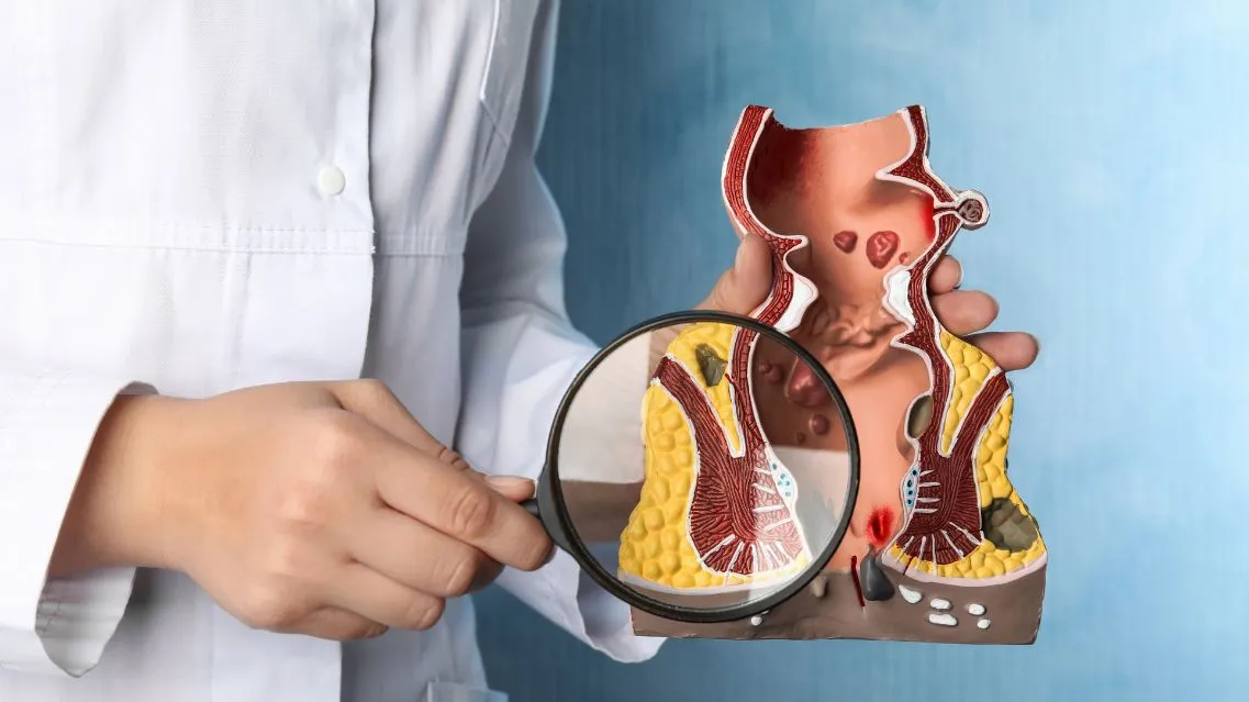 Trĩ cấp độ 3 uống thuốc có khỏi không? Cách điều trị trĩ độ 3 hiệu quả