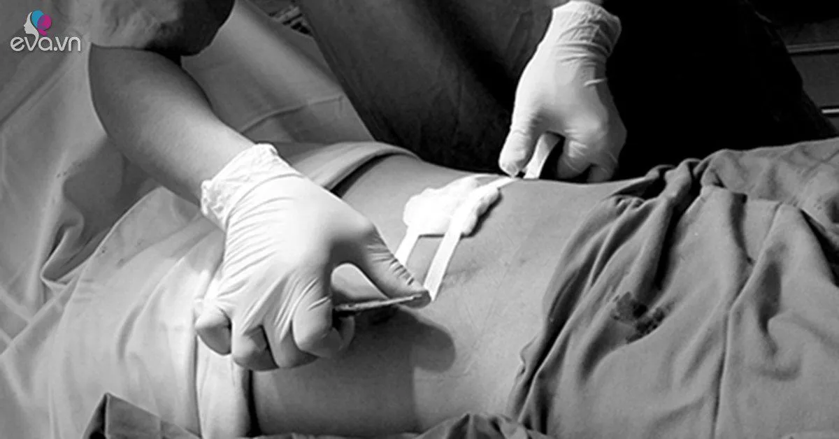 "Kinh hoàng" trước biến chứng nguy hiểm mà chị em có thể gặp phải khi hút mỡ bụng