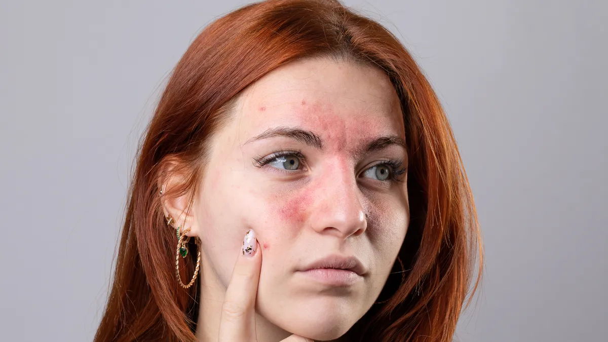 Những ai dễ mắc bệnh Lupus? Các biện pháp kiểm soát bệnh Lupus ban đỏ